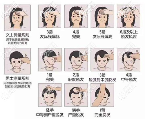 發(fā)際線手指自測圖 發(fā)際線手指自測圖
