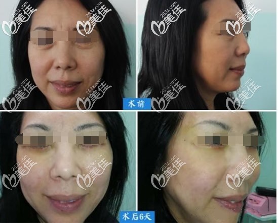 真人外切眼袋加面中部提升前后對(duì)比照片