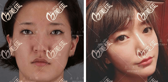 北京上上相全面部脂肪填充案例 北京上上相全面部脂肪填充案例