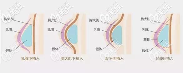 隆胸假體放置的位置