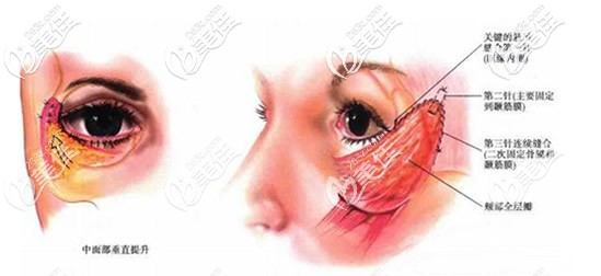 眼袋切口中面部提升術原理