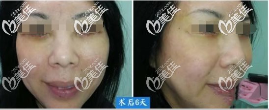 眼袋切口中面部提升案例圖