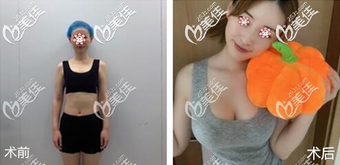 杭州隆胸好的醫(yī)院格萊美案例