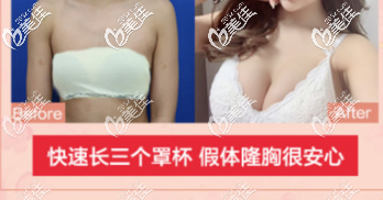 北京藝星醫(yī)療美容醫(yī)院假體隆胸案例