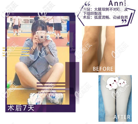 北京雅靚多維立體吸脂案例 北京雅靚多維立體吸脂案例