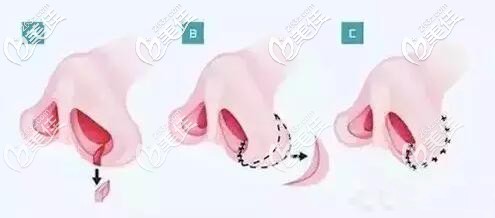 鼻翼切除術(shù)原理