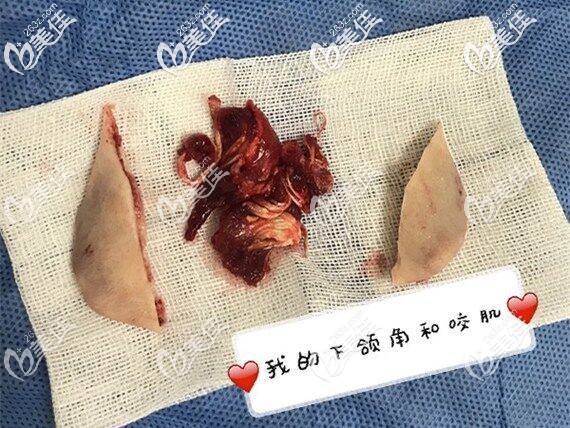 跟著下頜角一塊切除的咬肌 跟著下頜角一塊切除的咬肌