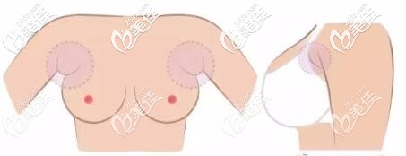 副乳長的部位示意圖