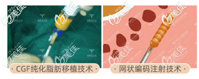 北京潤(rùn)美玉之光王明利脂肪移植技術(shù)手術(shù)示意圖 北京潤(rùn)美玉之光王明利脂肪移植技術(shù)手術(shù)示意圖