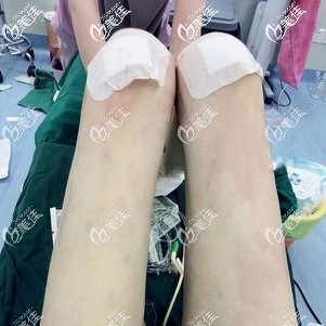 威塑吸脂瘦腿術(shù)后即刻