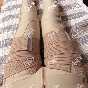 腿部抽脂術(shù)后7天腫脹輕微