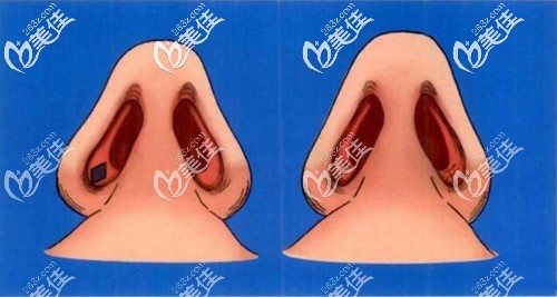 鼻孔內(nèi)切原理