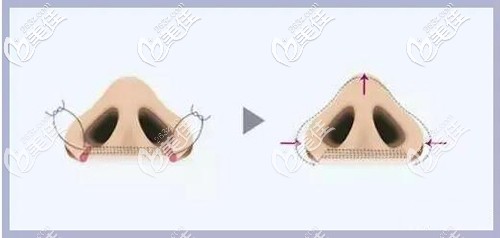鼻孔聚攏原理