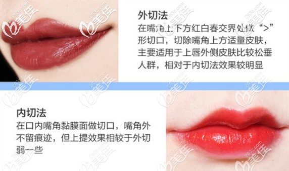 內(nèi)切和外切嘴角上揚(yáng)術(shù)區(qū)別