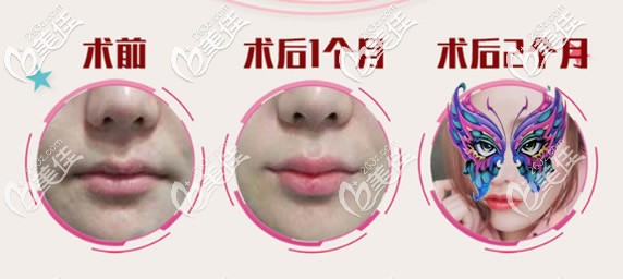 嘴角上揚(yáng)手術(shù)2個(gè)月效果
