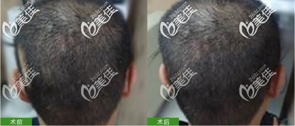 想了解本院植發(fā)怎么樣,就來(lái)看看這三則頭部疤痕植發(fā)案例效果好不好!