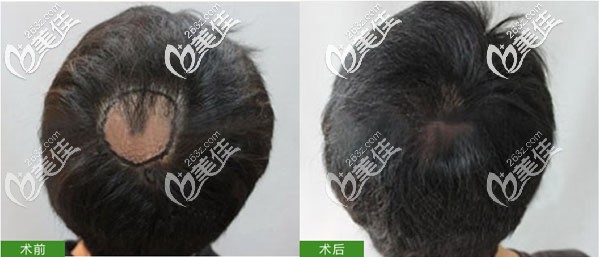 長沙岱高頭部意外疤痕植發(fā)成功 長沙岱高頭部意外疤痕植發(fā)成功