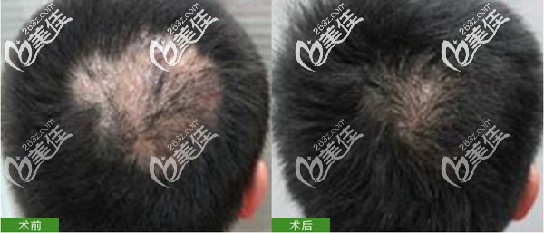 長沙岱高頭部燙傷疤痕植發(fā) 長沙岱高頭部燙傷疤痕植發(fā)