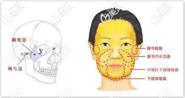 微創(chuàng)十五分鐘顴骨內(nèi)推原理介紹