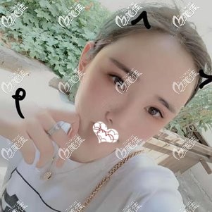 術(shù)后15天面部線條更加流暢柔和