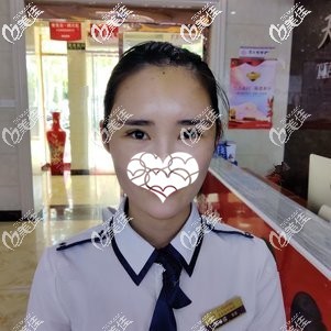 自體脂肪填充蘋果肌術(shù)后5天全臉微腫