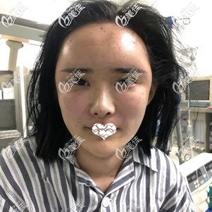 剛做完脂肪填充面部手術(shù)后腫脹感較強(qiáng)