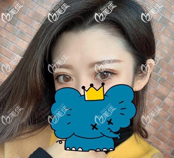 ?分享女士植發(fā)際線一年效果圖,還有女生種植發(fā)際線需不需要剃頭發(fā)的秘密