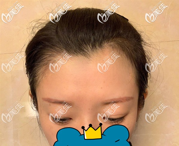 2我發(fā)際線是天生就比較高看著顯老 2我發(fā)際線是天生就比較高看著顯老