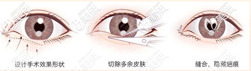 汕頭愛(ài)都滬美人雙眼皮手術(shù)演示圖