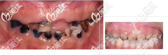 乳牙齲齒 乳牙齲齒