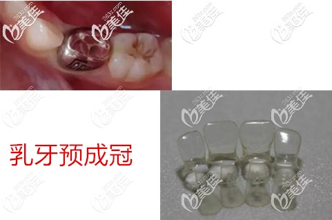 乳牙金屬和透明預成冠 乳牙金屬和透明預成冠