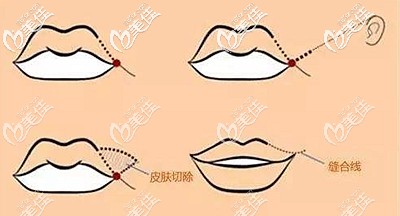 嘴角上揚(yáng)手術(shù)的原理