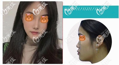 做耳軟骨隆鼻后的效果對比 做耳軟骨隆鼻后的效果對比