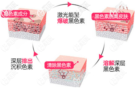 激光去黑眼圈原理示意圖