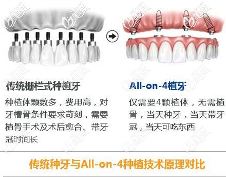 傳統(tǒng)種牙與ALL-ON-4種植技術(shù)對(duì)比