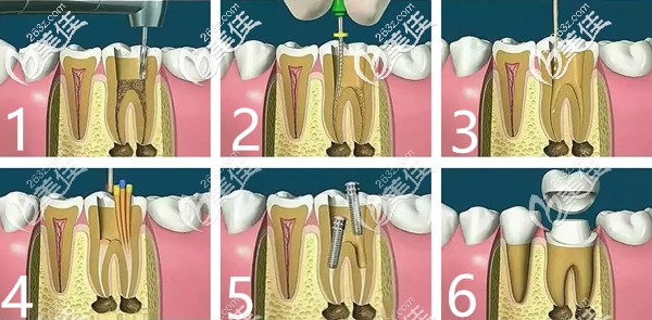 根管治療的過程圖解 根管治療的過程圖解