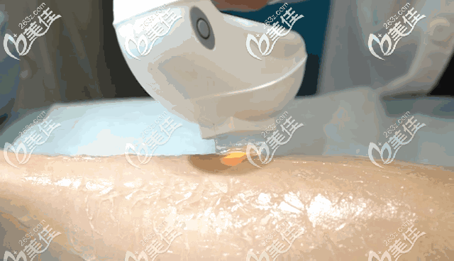 冰點脫毛的操作 冰點脫毛的操作