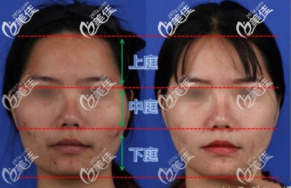 面部可以分為上庭中庭和下庭三部分 面部可以分為上庭中庭和下庭三部分