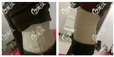 腰腹環(huán)吸后一周 腰腹環(huán)吸后一周