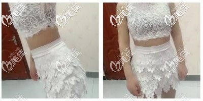 腰腹抽脂后一個月恢復 腰腹抽脂后一個月恢復