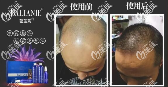 芭蓮妮尊榮生發(fā)效果 芭蓮妮尊榮生發(fā)效果