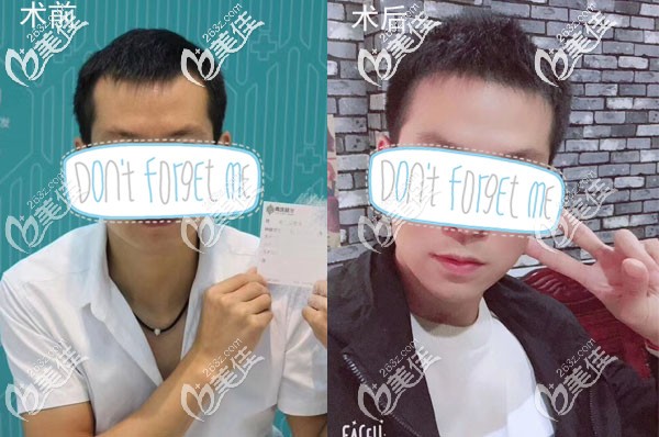 深圳青逸額角發(fā)際線種植案例效果 深圳青逸額角發(fā)際線種植案例效果