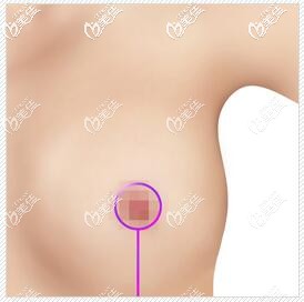 標(biāo)準(zhǔn)的乳房縮小手術(shù)方法 標(biāo)準(zhǔn)的乳房縮小手術(shù)方法