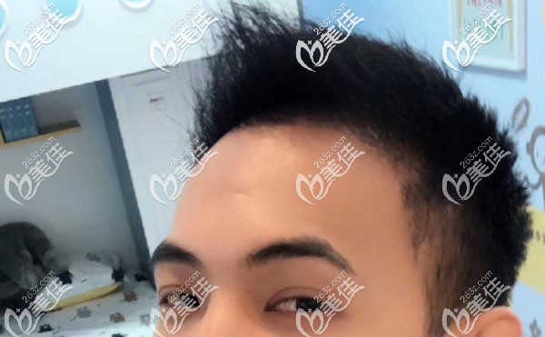 遺傳性脫發(fā)有救嗎?分享我發(fā)際線種植+頭頂加密種植自救寶典（內有效果圖）