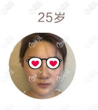 外切縮小鼻頭鼻翼和綜合隆鼻前 外切縮小鼻頭鼻翼和綜合隆鼻前