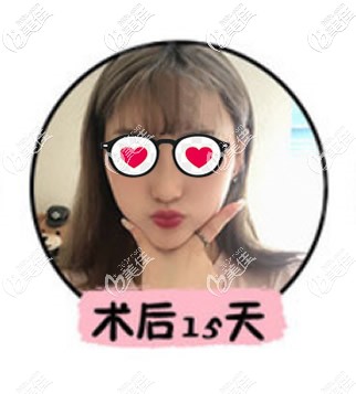 隆鼻縮小鼻頭鼻翼15天效果 隆鼻縮小鼻頭鼻翼15天效果