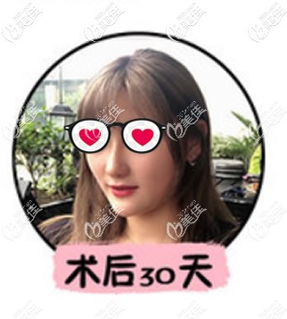 鼻綜合整形1個月恢復(fù)圖 鼻綜合整形1個月恢復(fù)圖