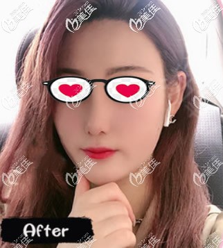 外切鼻頭鼻翼縮小親身經(jīng)歷:用這種方法隆鼻2個(gè)月后鼻子比之前小了好多！