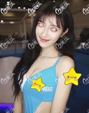 去泰國咖蒙KAMOL醫(yī)院做300cc曼托假體胸感觸特深的一點(diǎn)是他們的型號(hào)和尺寸很全