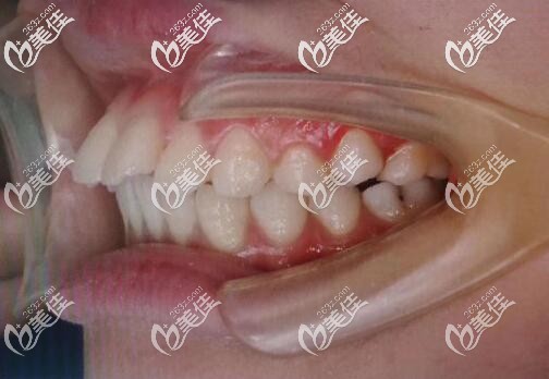 門牙前突矯正前的照片